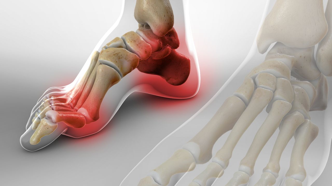 Cavus foot (high arch) profile