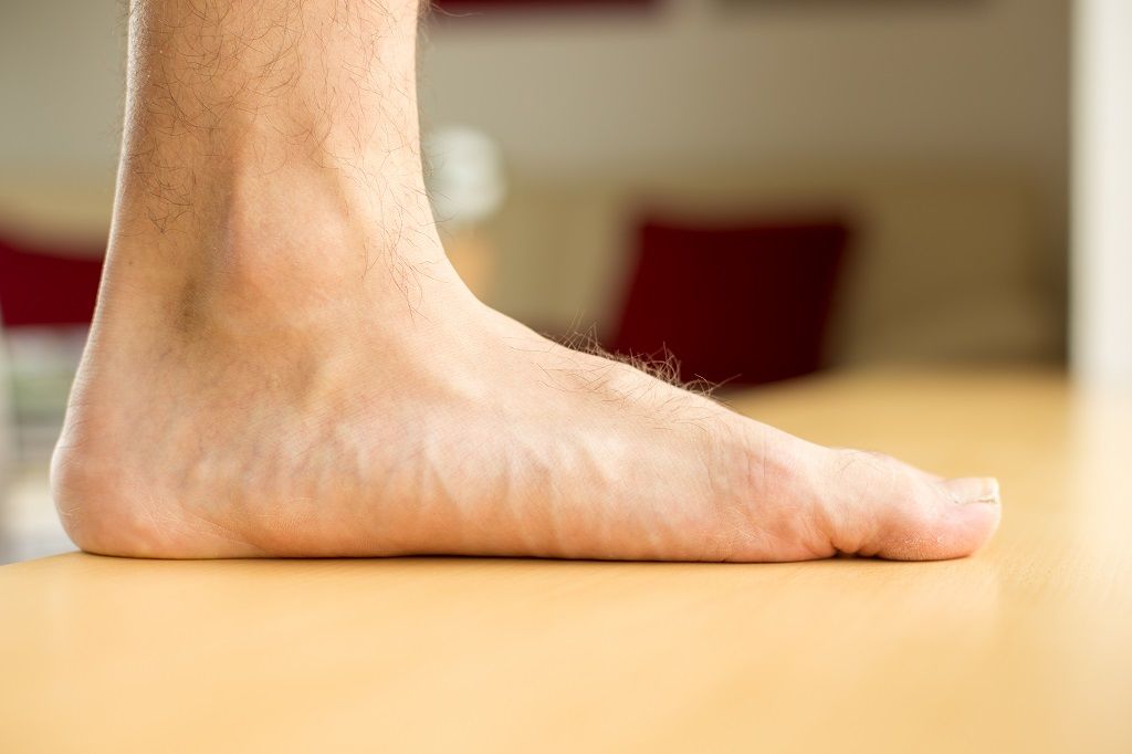 Flat feet arch comparison