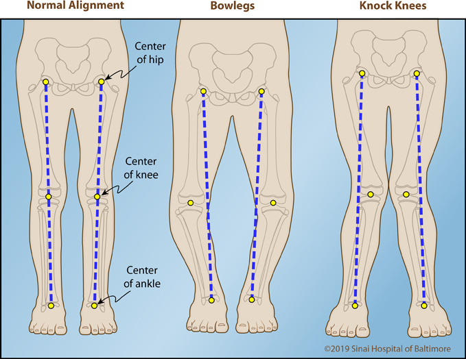 Bowlegs leg alignment diagram
