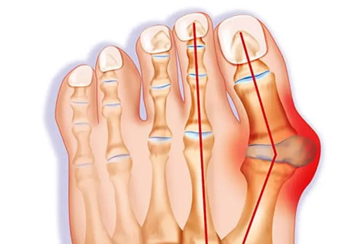 Bunion (hallux valgus) illustration