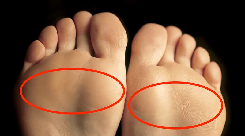 Forefoot pressure map showing metatarsalgia